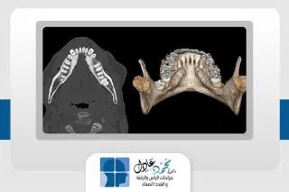 نتوء الفك السفلى المستدير