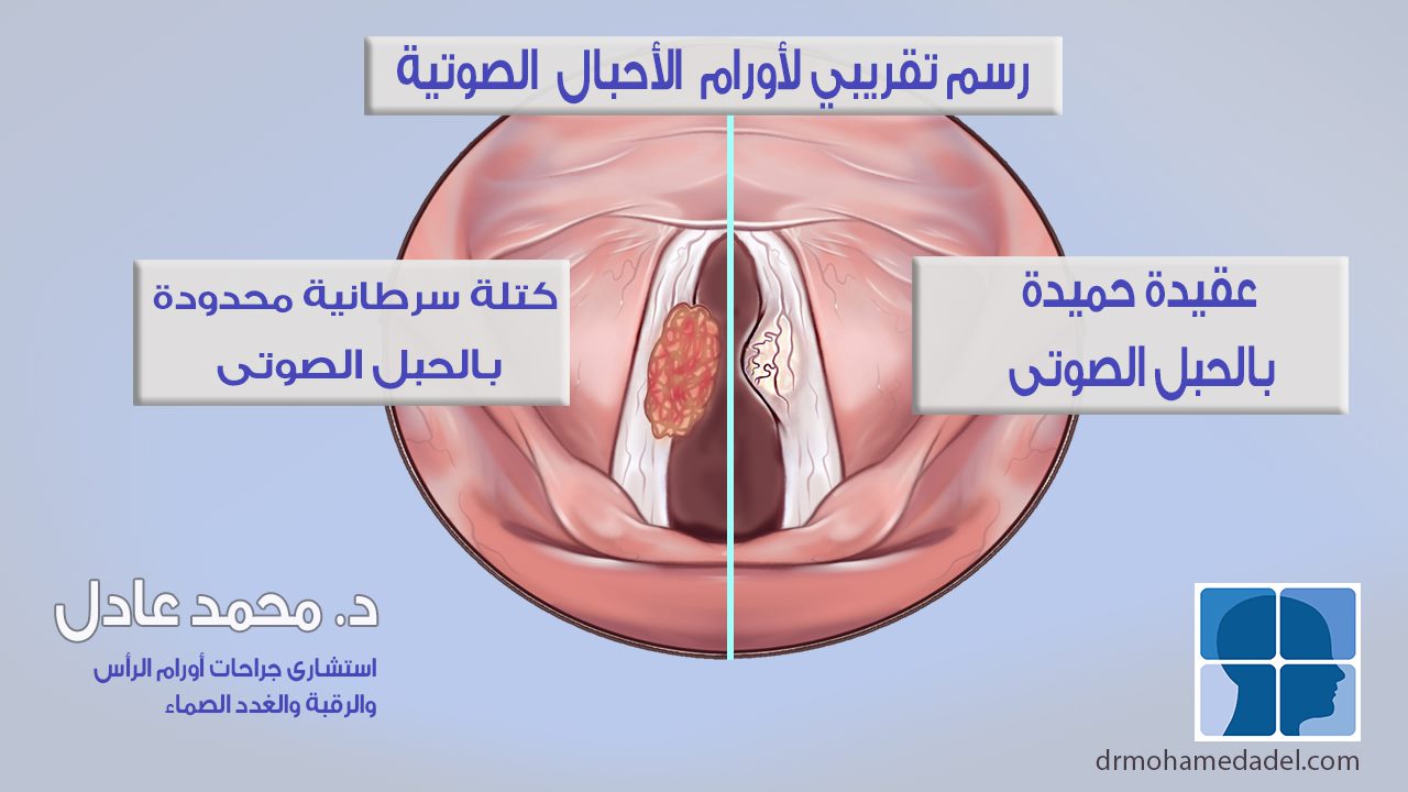 larynx 1