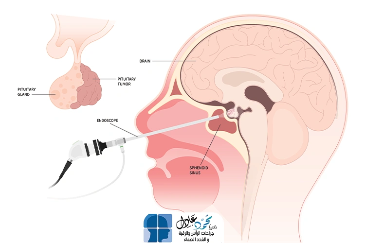 تكلفة عملية استئصال ورم الغدة النخامية في مصر